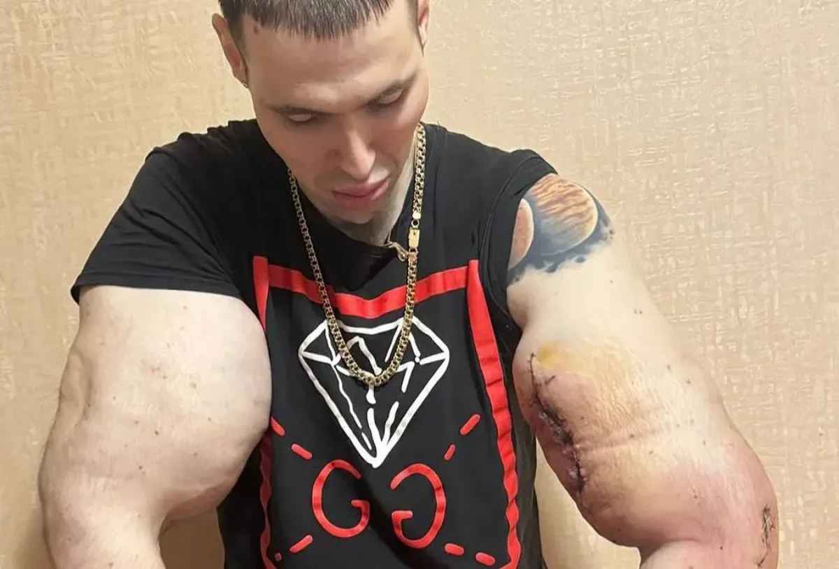 Ruský Pepek námořník, který napumpoval bicepsy olejem, podstoupil další operaci