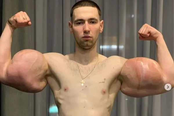 Ruský Pepek námořník přišel o bicepsy. Má je zdeformované
